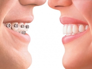 Aligning the Teeth
