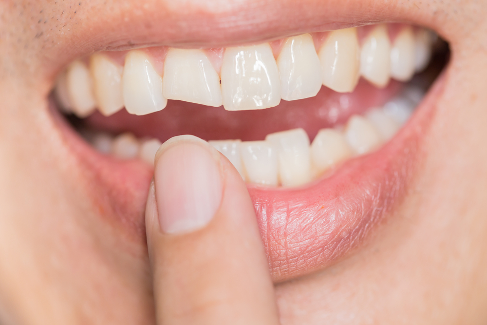 Tooth Filling & Restoration