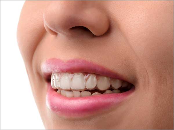 Invisible Braces