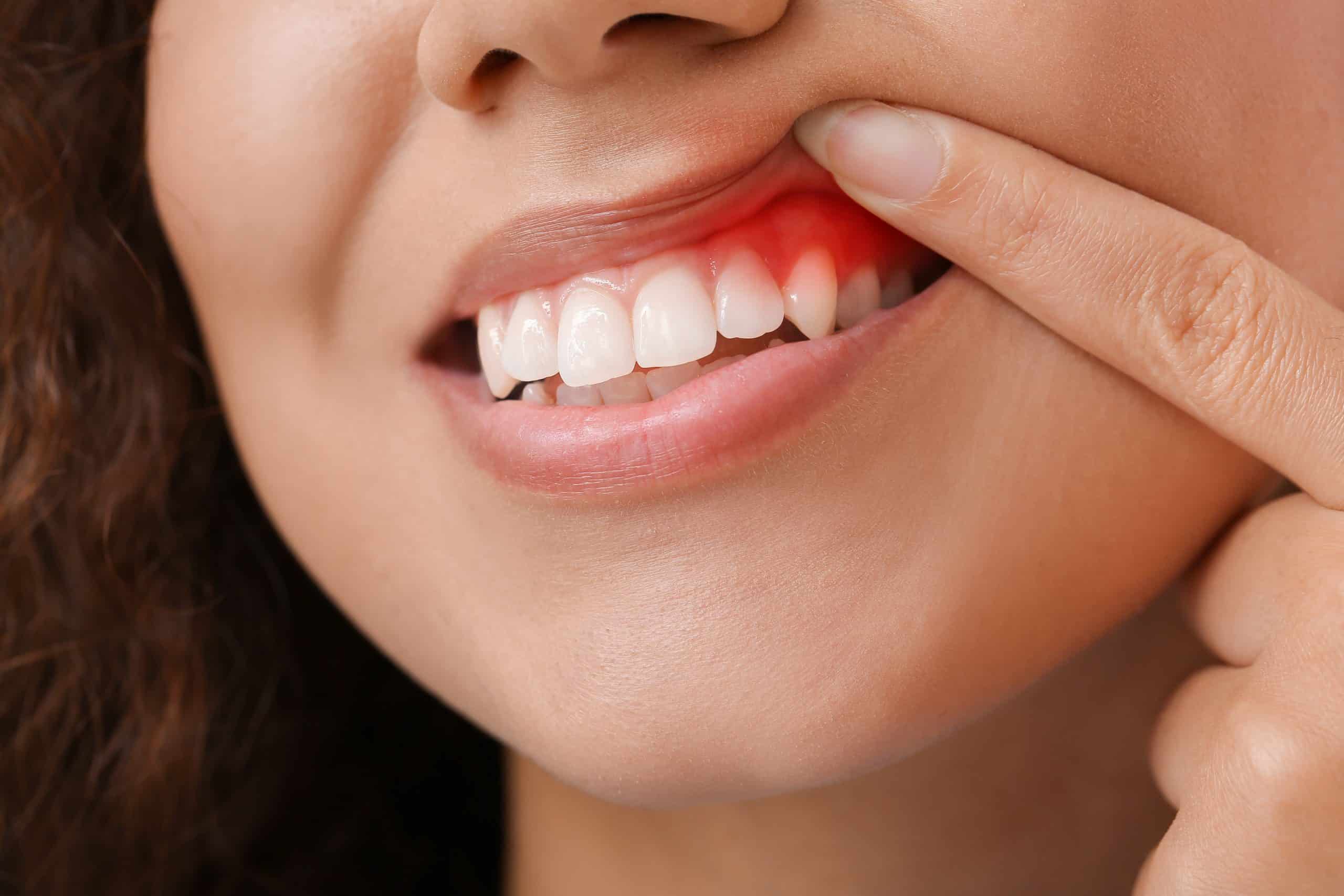 Advanced Gum Treatment